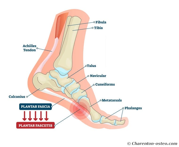 Comment soulager la douleur sous le pied : 7 conseils 1 douleur sous le pied